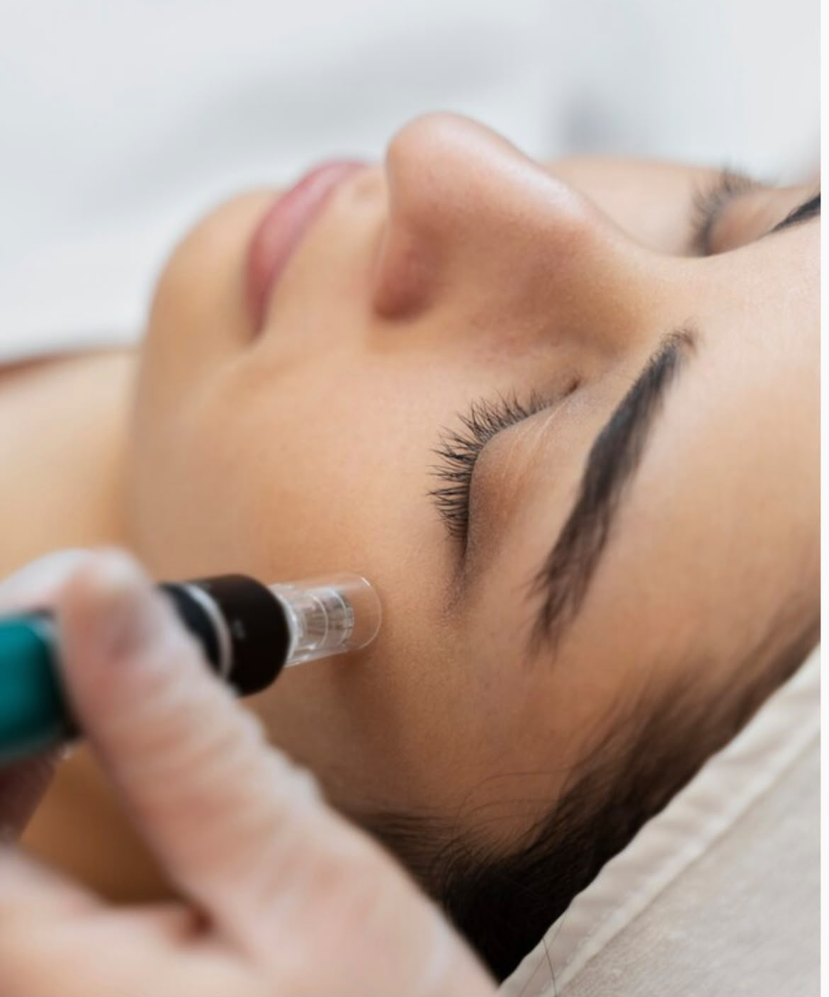 Sesión de Dermapen con ácido hialurónico al 1% en Va de Luxe